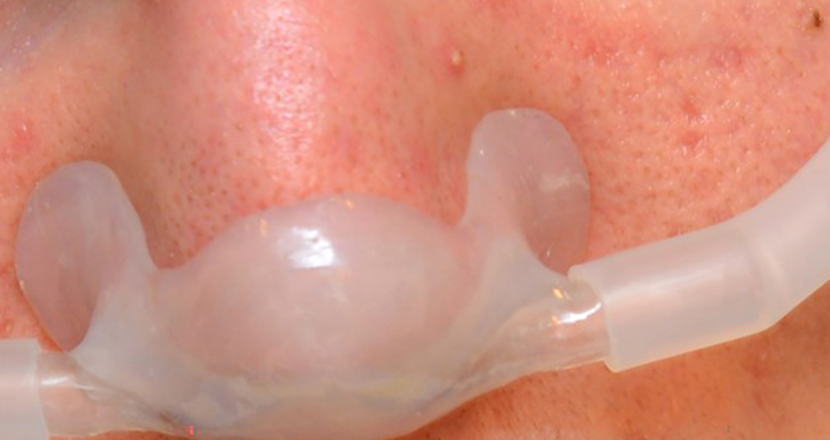 Närbild på en person med andningshjälp genom näsan. Foto.