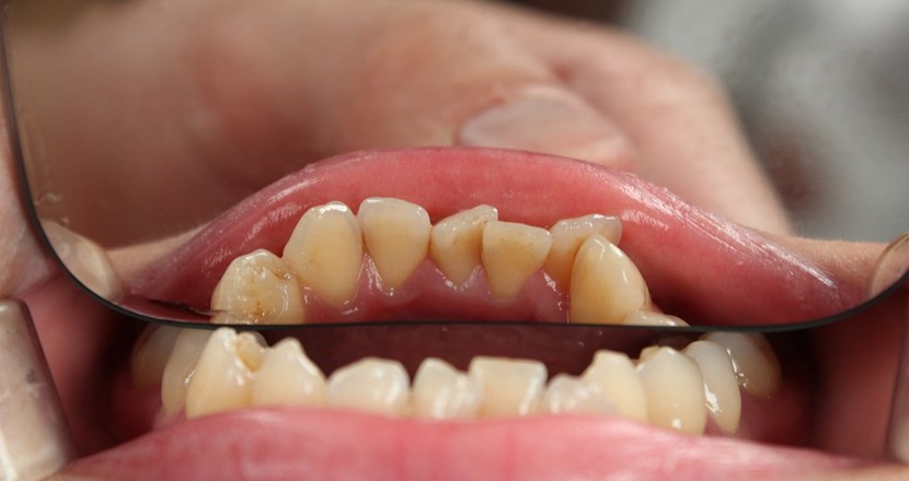 Tänder som undersöks med en spegel. Foto.