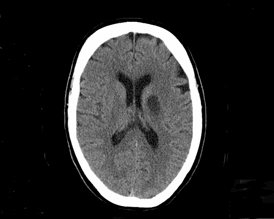 Röntgenbild på blodpropp i hjärnan