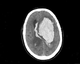 Röntgenbild på hjärnblödning