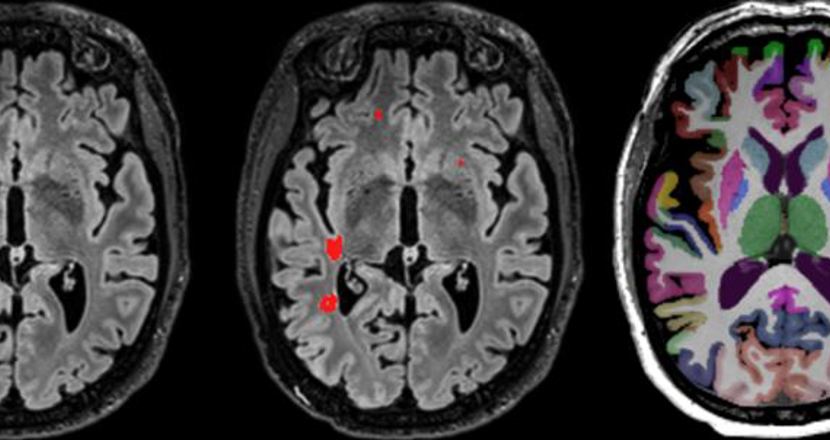 Bilder tagna på hjärnan med MR-kamera