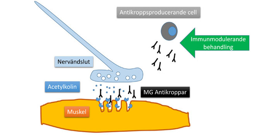 En skiss över hur antikropparna störs vid myastenia gravis, mg