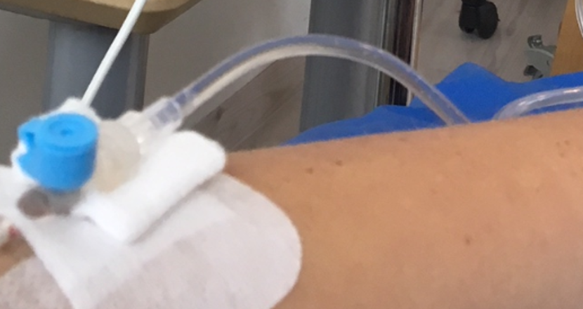 Dropp av läkemedel i arm