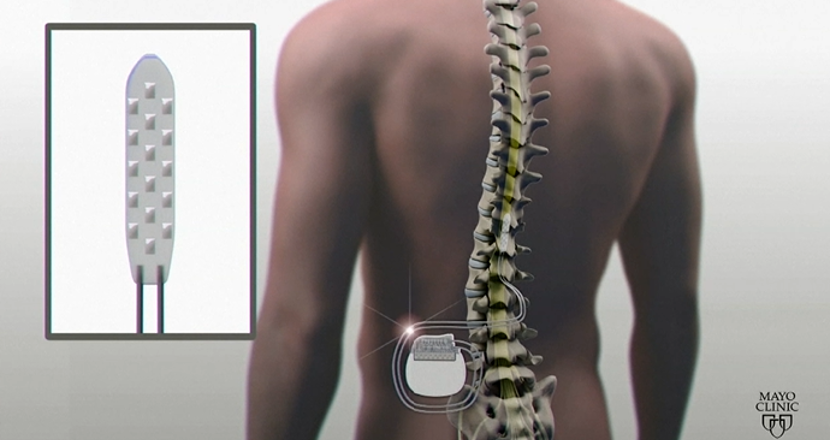 Illustration av elstimulering av ryggmärgen