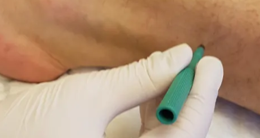 Foto på att ta hudbiopsi på ben.