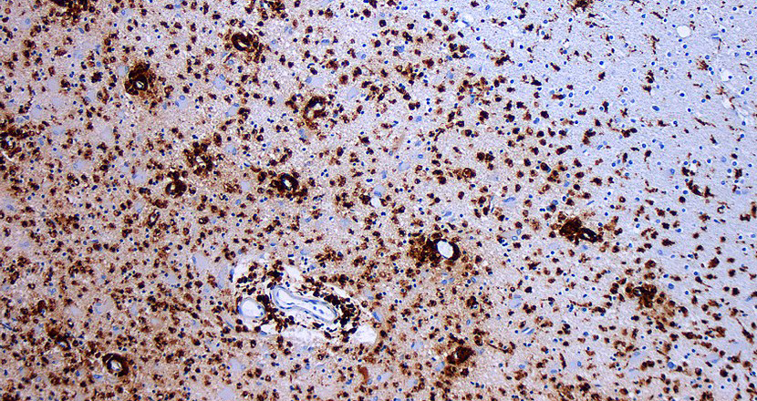 Nedbrytning av Myelin. Mikrofoto. 